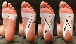 fascite plantare e piede pronato