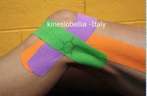 Powerful taping kinesiobellia - stabilizzazione per sindrome della bendelletta ileo-tibiale