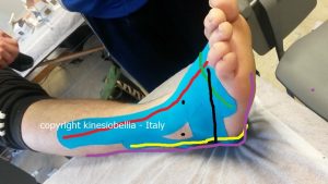 Powerful taping kinesiobellia - stabilizzazione biomeccanica della tibio-tarsica