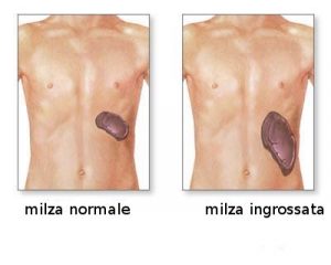 milza-ingrossata-5