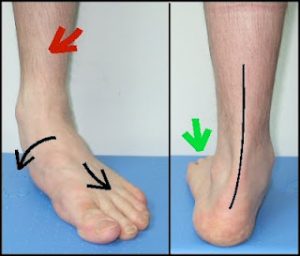 pronazione-eccessiva-del-piede