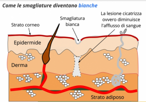 smagliatura cutanea