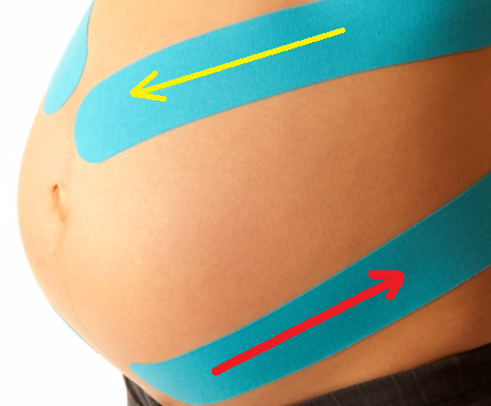 Applicazione del Taping kinesiologico® durante la GRAVIDANZA e fase  post-parto – Bellia Rosario