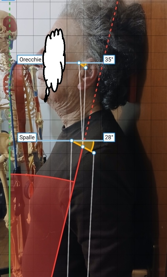 rilevazione angoli della colonna cervicale dopo trattamento