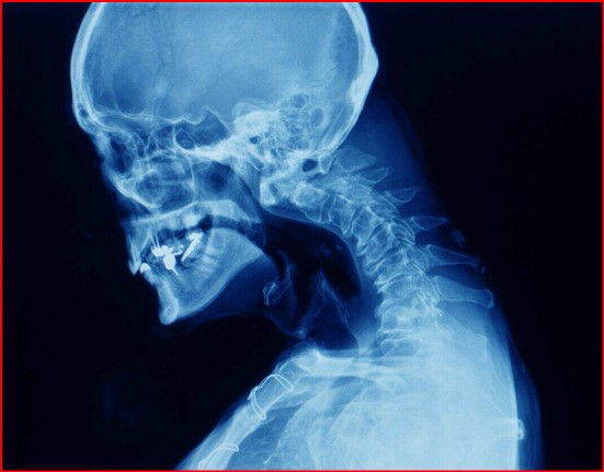 esempio di radiografia